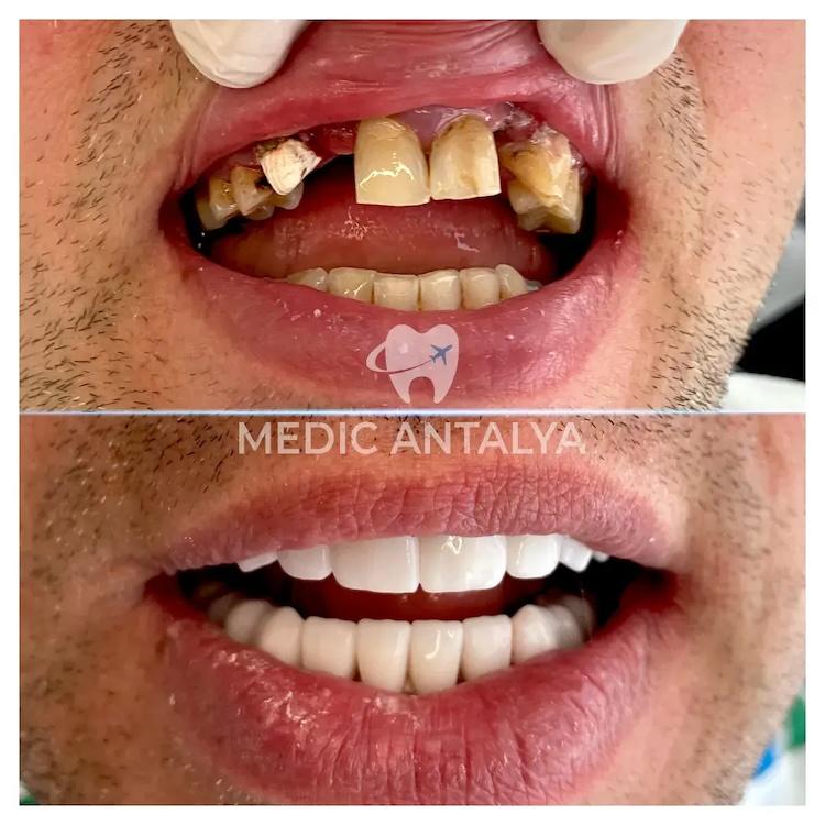 Medic antalya - Dental results14