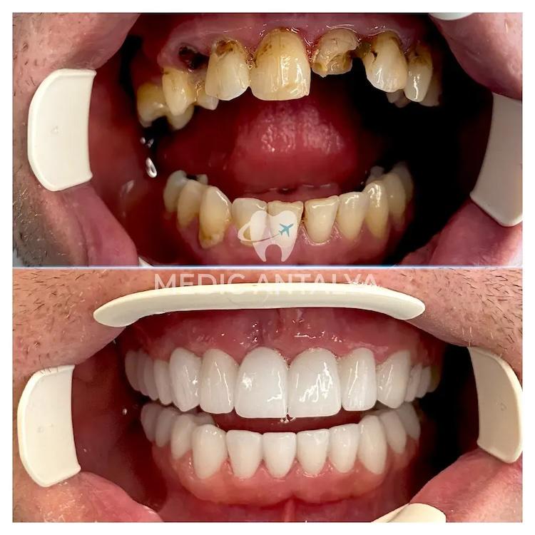 Medic antalya - Dental results16