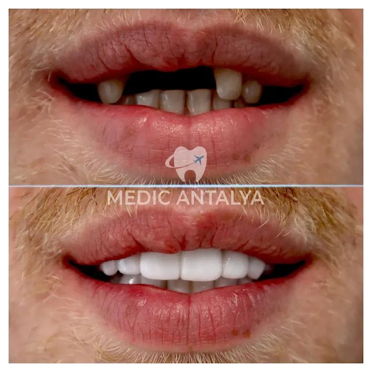 Medic antalya - Dental results18
