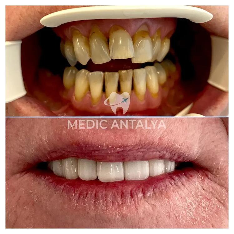 Medic antalya - Dental results19