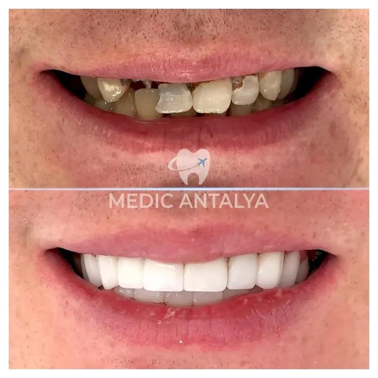 Medic antalya - Dental results23
