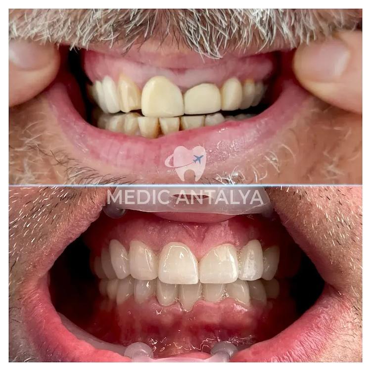 Medic antalya - Dental results30