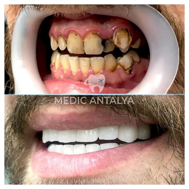 Medic antalya - Dental results32