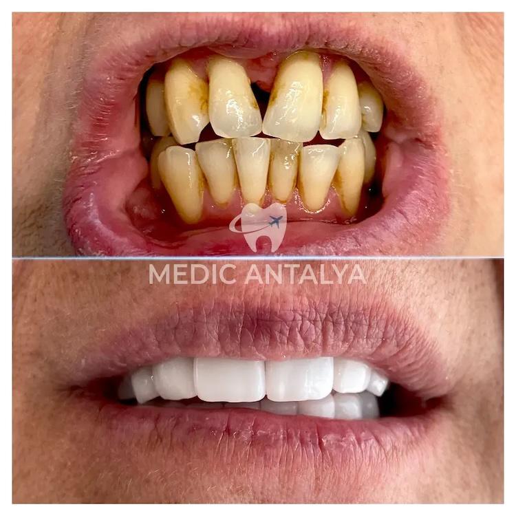 Medic antalya - Dental results36