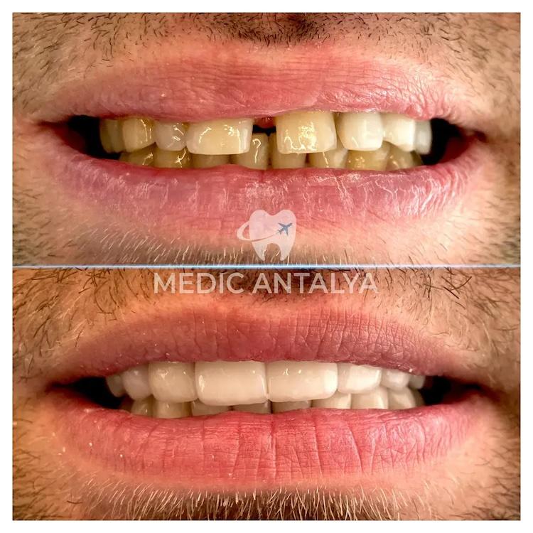 Medic antalya - Dental results1