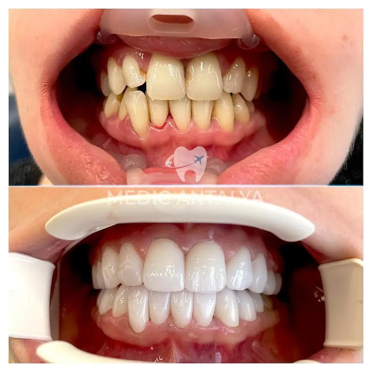 Medic antalya - Dental results3