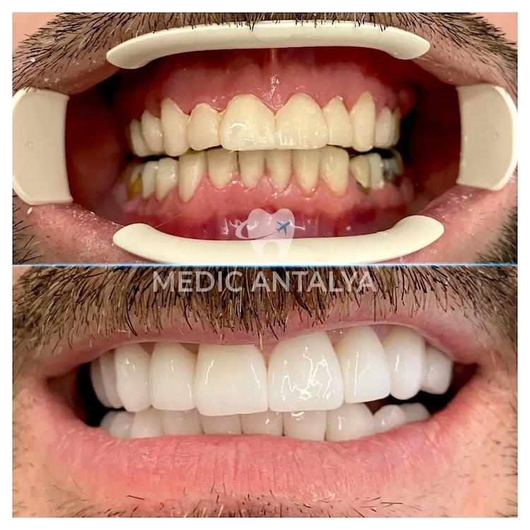 Medic antalya - Dental results17
