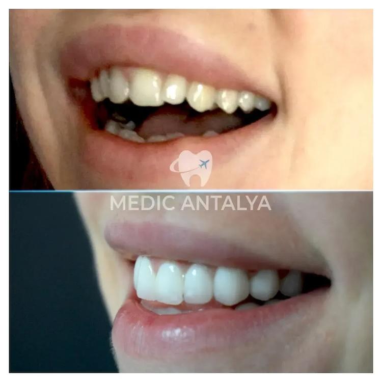Medic antalya - Dental results31