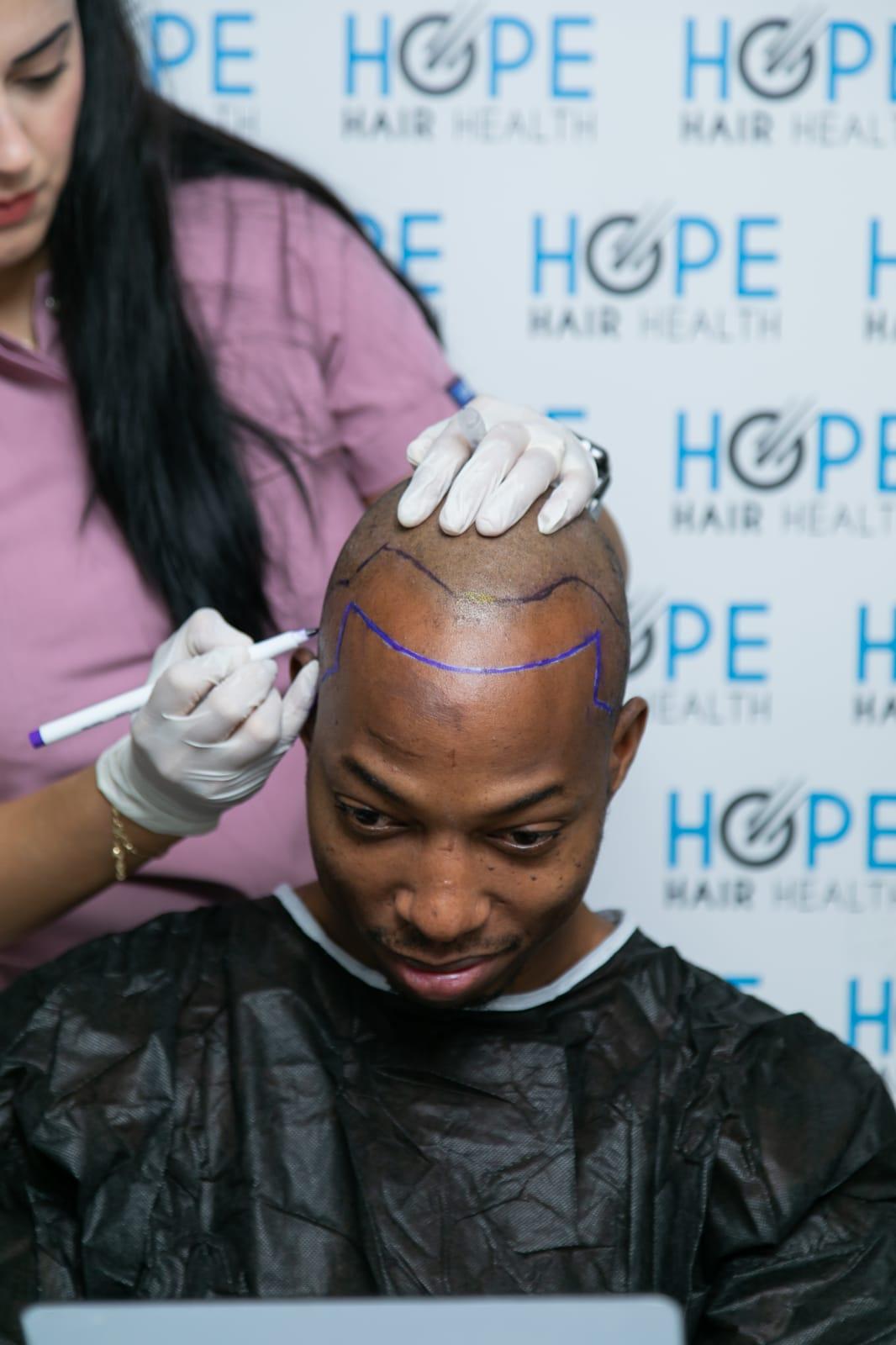 hope hair health - hair transplant results 20