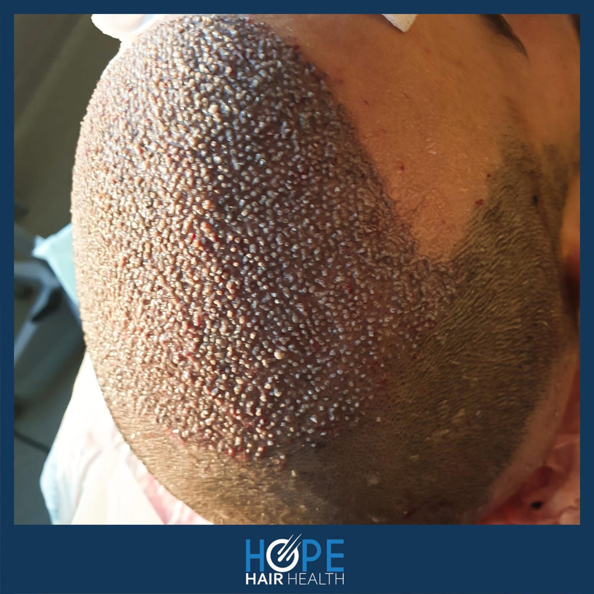 hope hair health - hair transplant results 14