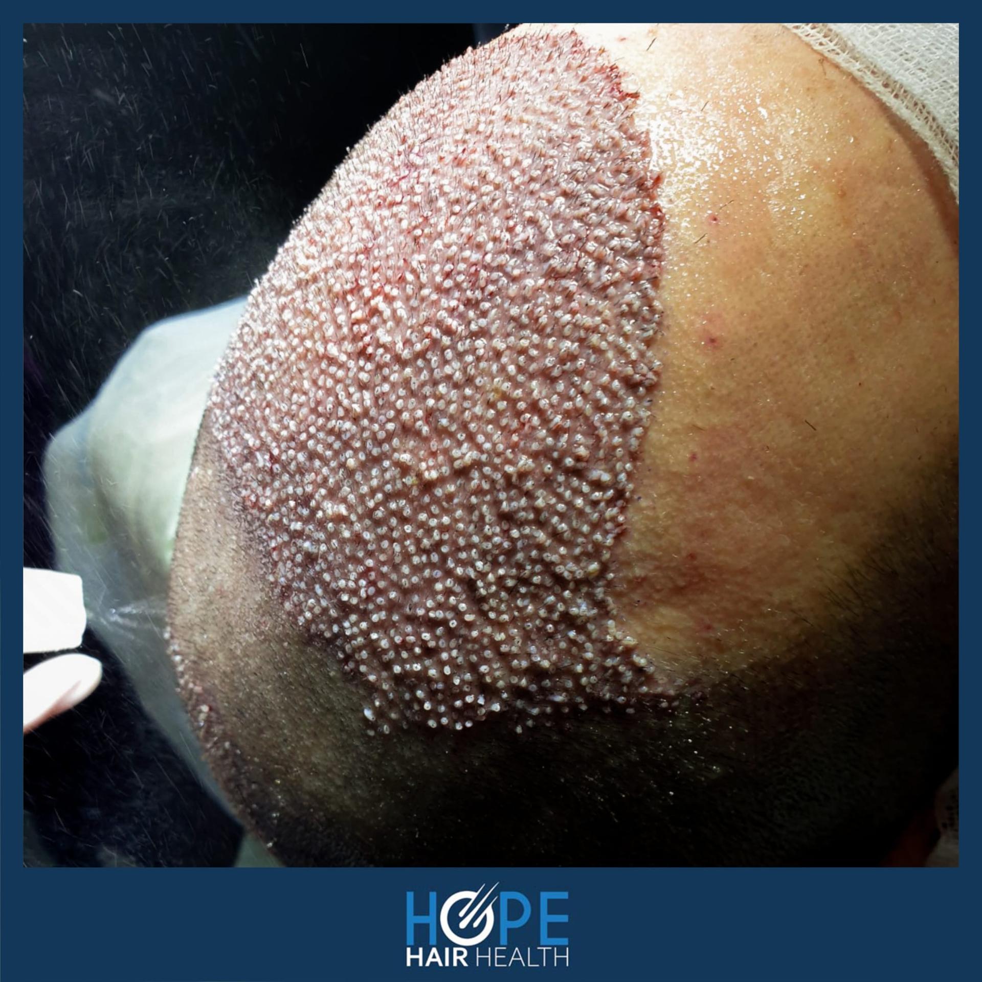 hope hair health - hair transplant results 15