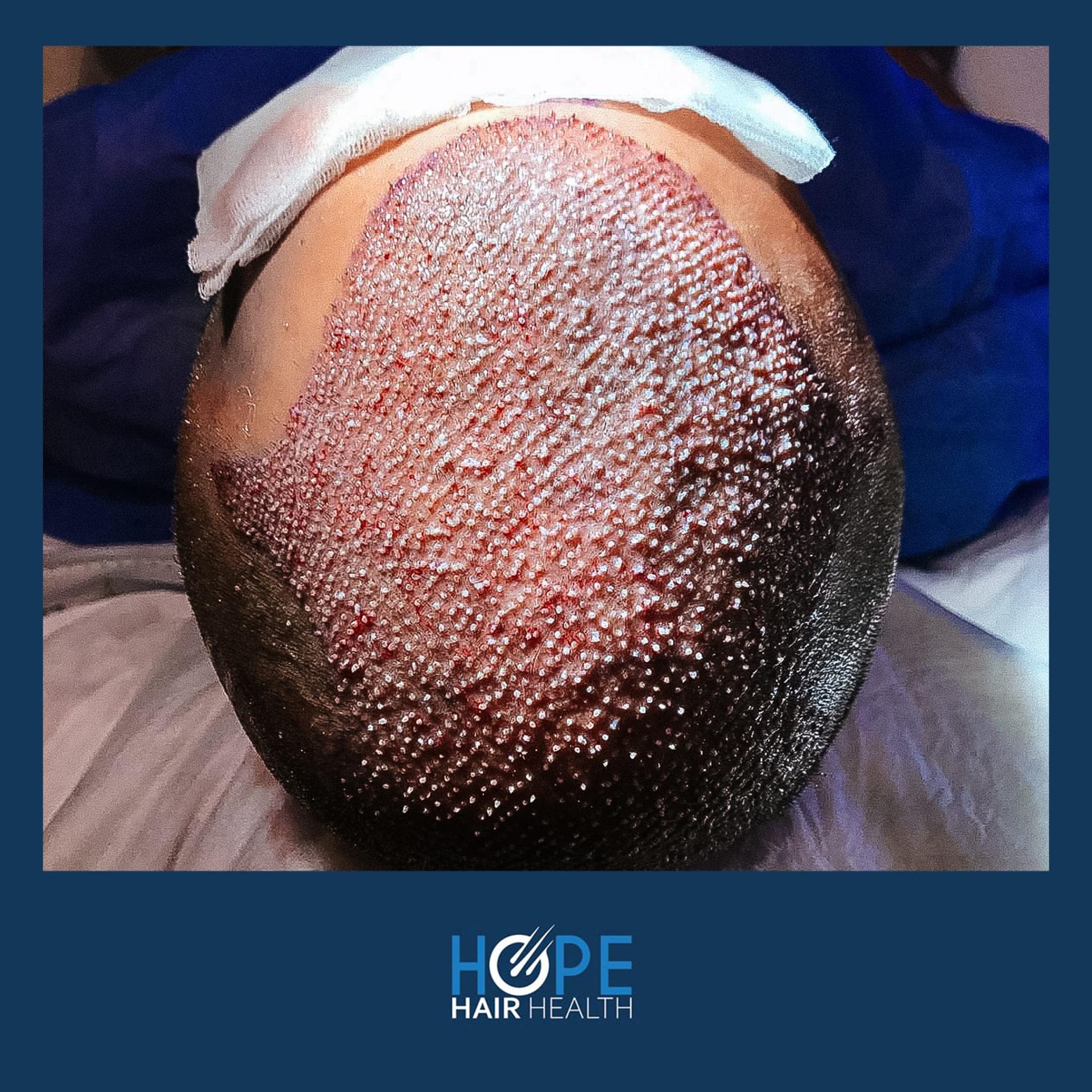 hope hair health - hair transplant results 3
