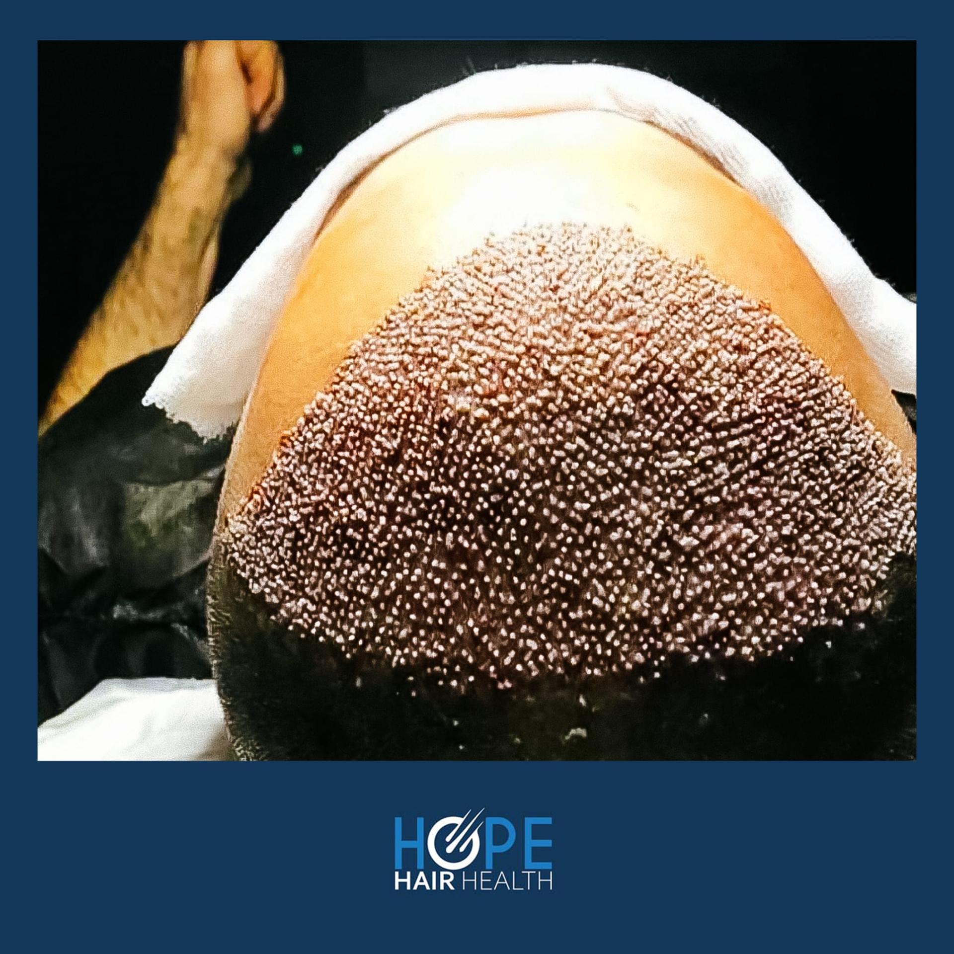 hope hair health - hair transplant results 4