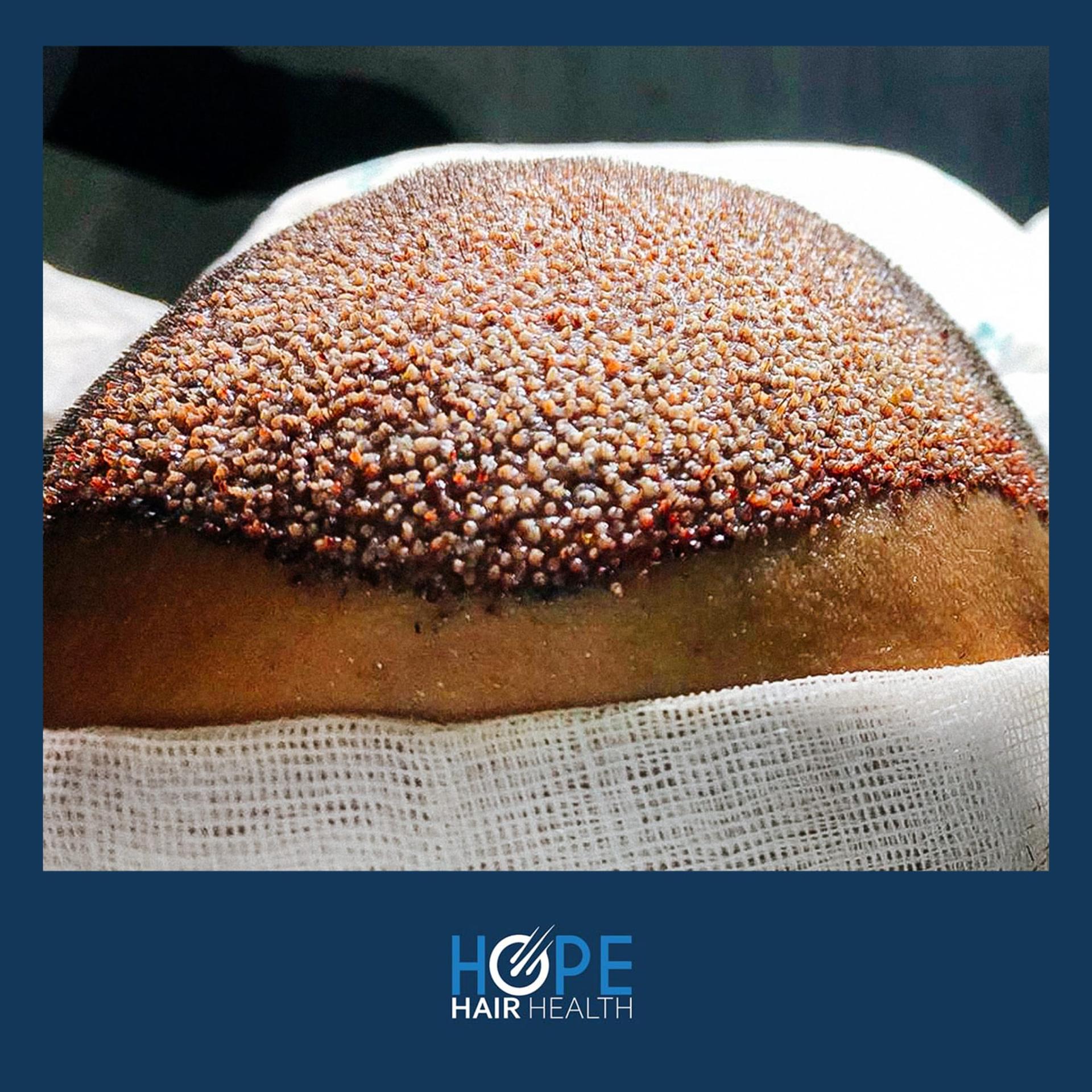 hope hair health - hair transplant results 5