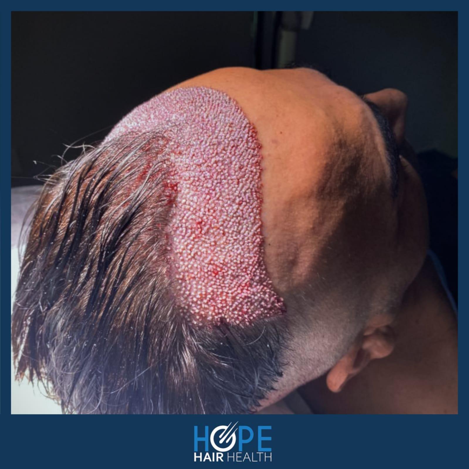 hope hair health - hair transplant results 11