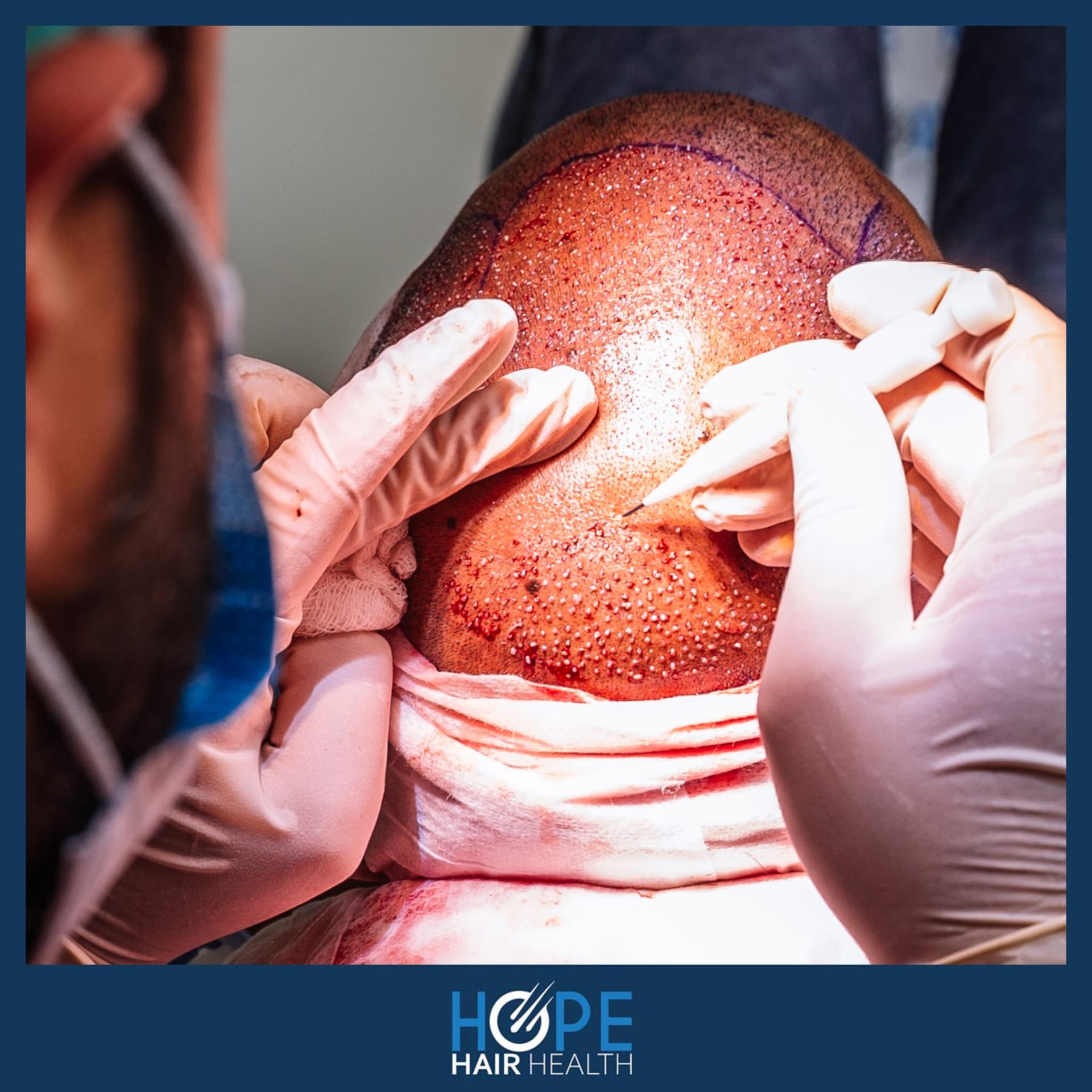 hope hair health - hair transplant results 8