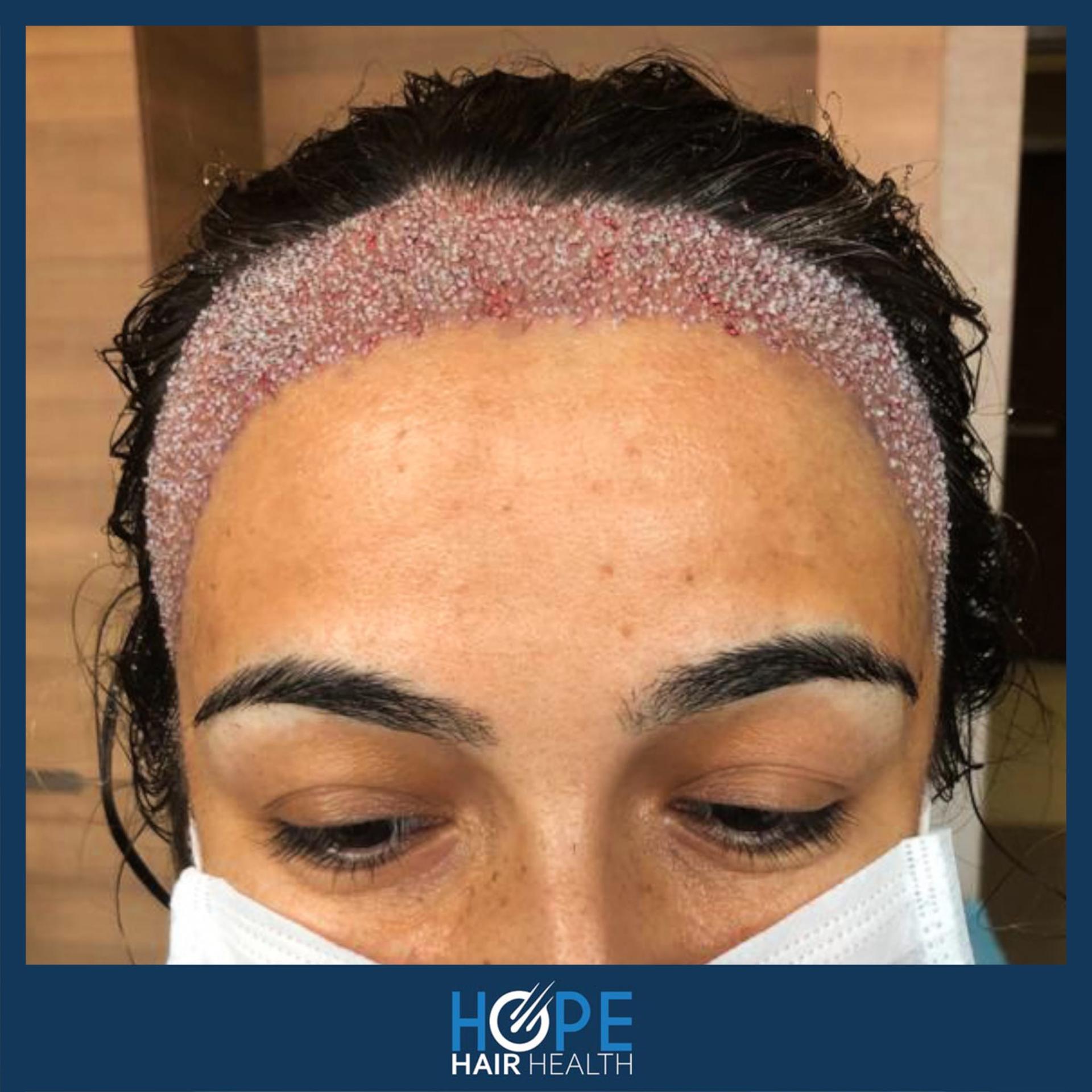 hope hair health - hair transplant results 9