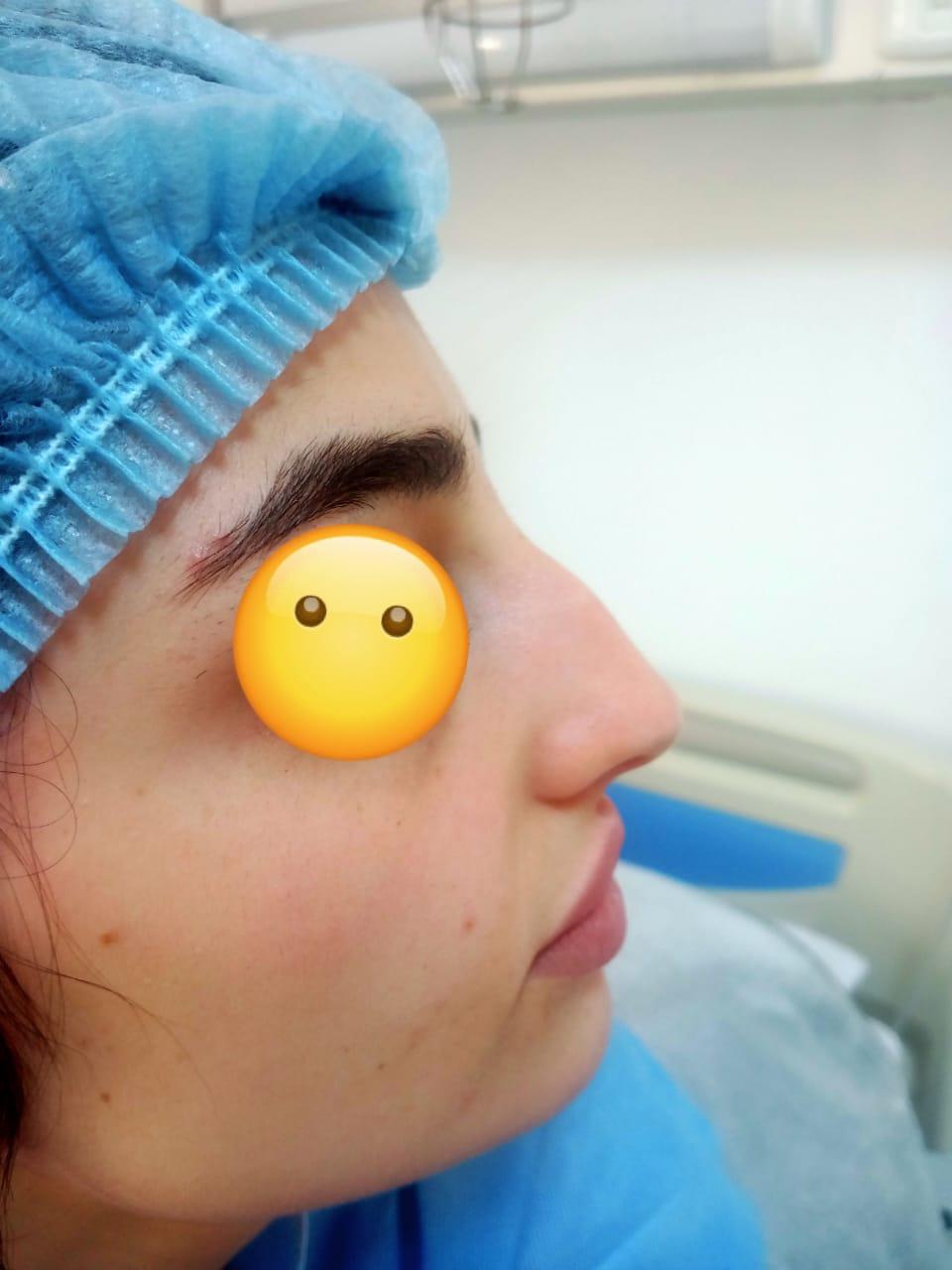 RHINOPLASTIE TUNISIE ZAGHOUAN6