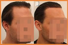 Dr Patrick Mwamba Hair transplant result 