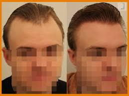 Dr Patrick Mwamba Hair transplant result 