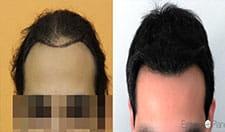 Résults by Dr Bisanga BHR