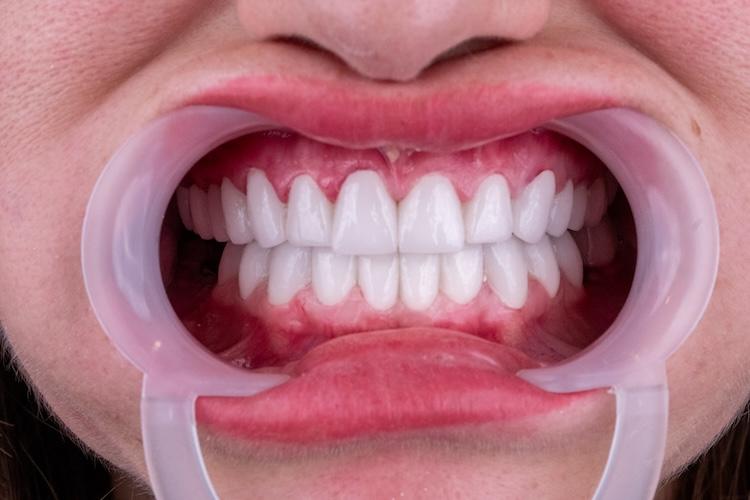 ZenSmileTown Dental Results12