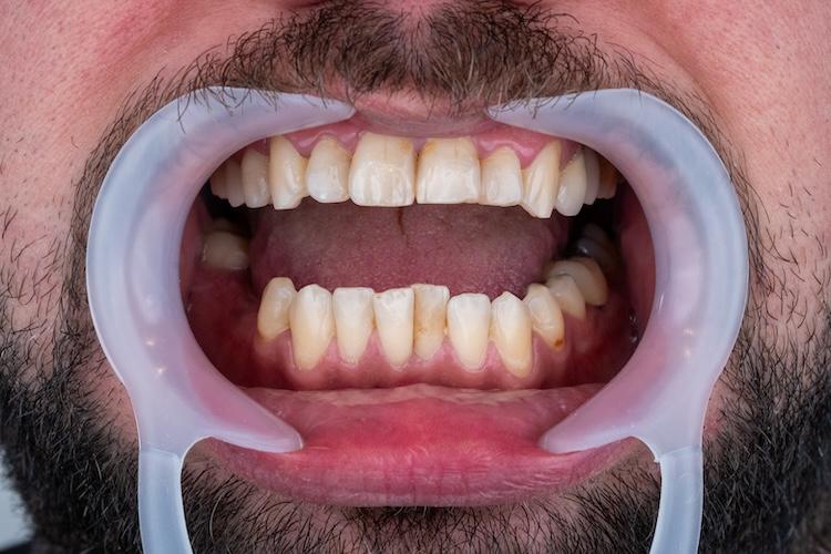 Before ZenSmileTown Dental Results30