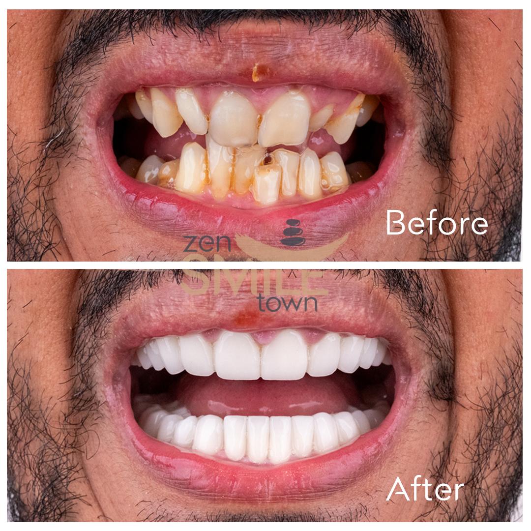ZenSmileTown Dental Results9