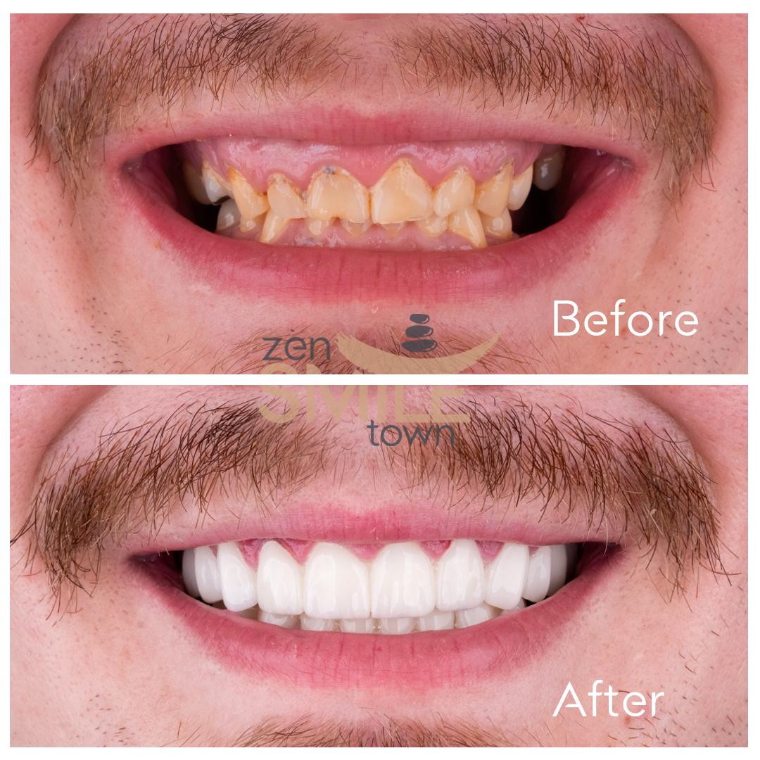ZenSmileTown Dental Results20
