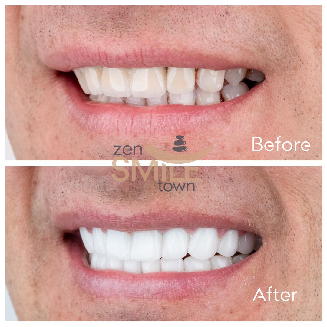 ZenSmileTown Dental Results4