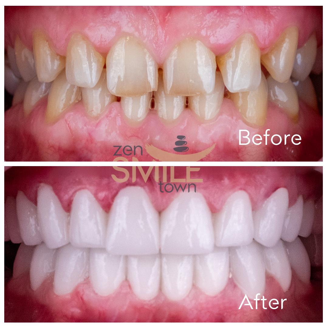 ZenSmileTown Dental Results21
