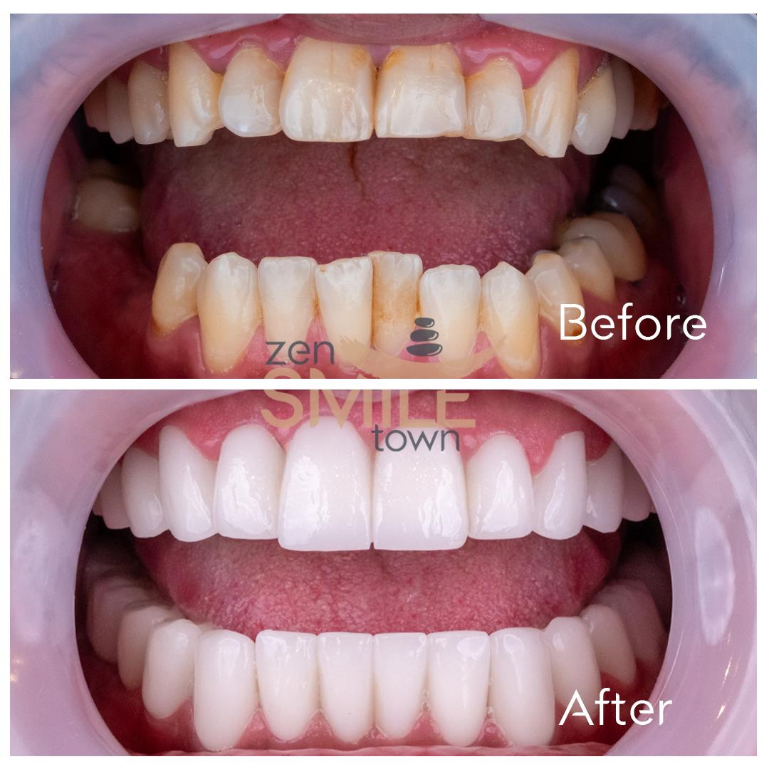 ZenSmileTown Dental Results23