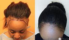 avant-apres-dr-bisanga-thumb1-min