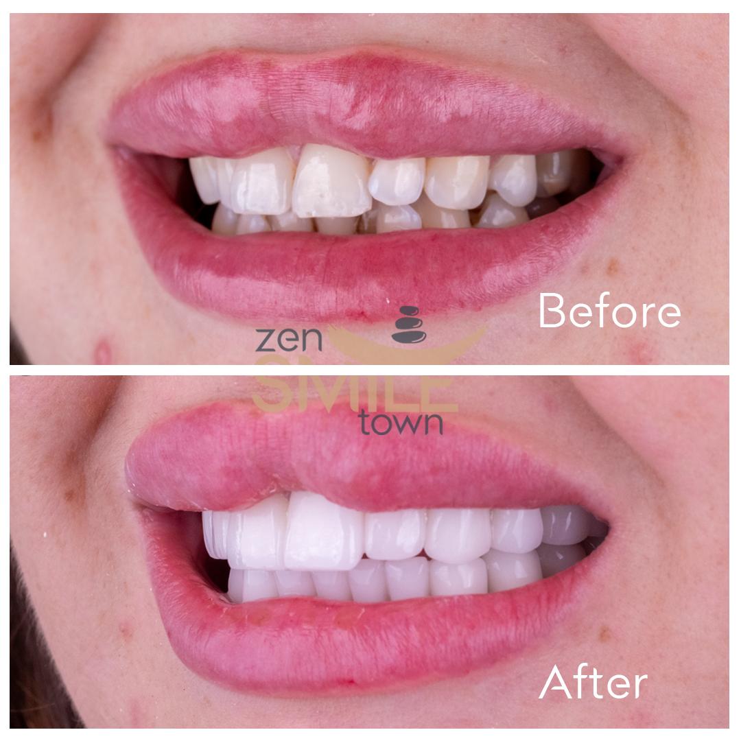 ZenSmileTown Dental Results25