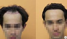 avant-apres-dr-bisanga-thumb2-min