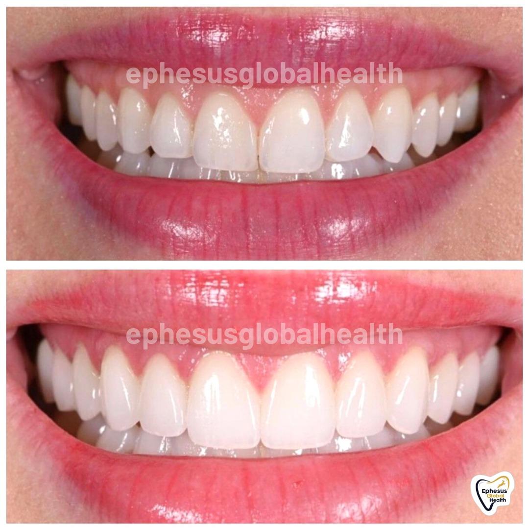 Ephesus dental results37
