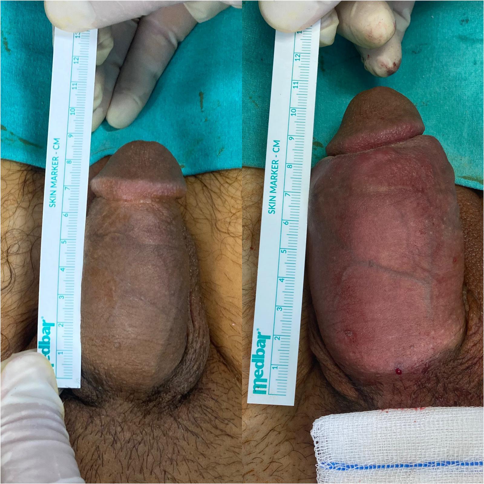 augpenien2