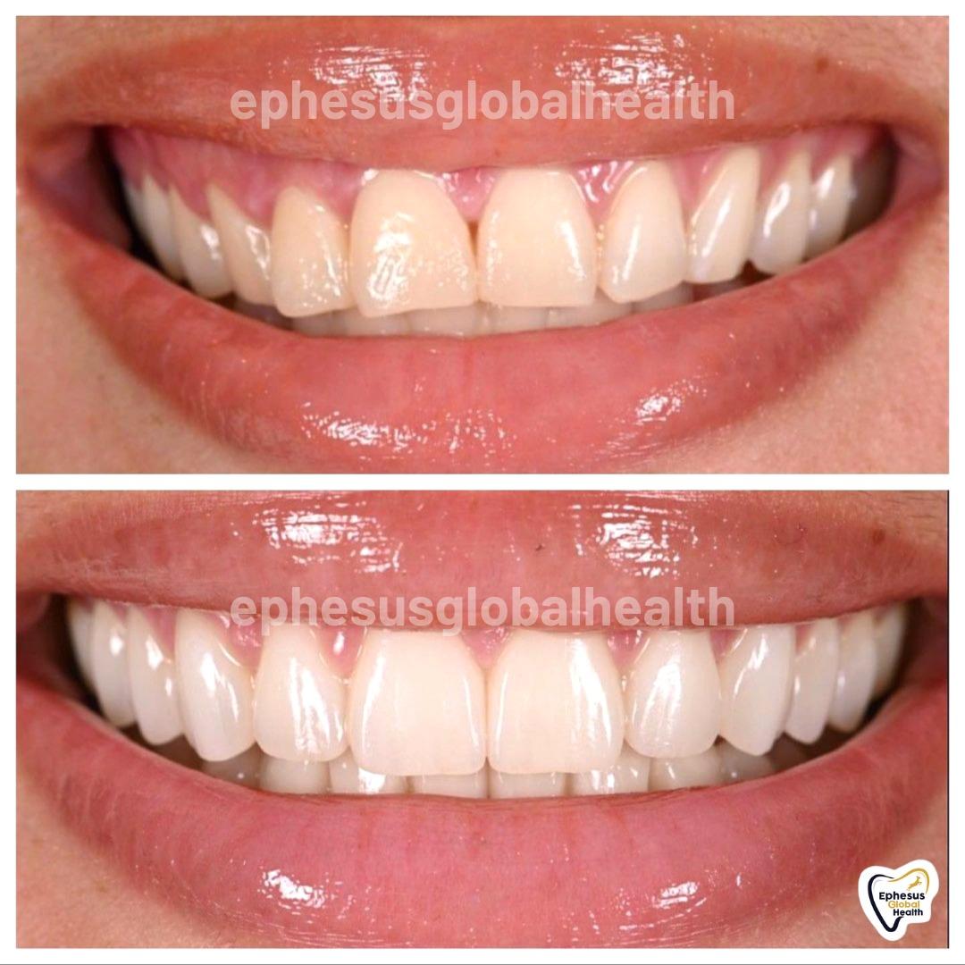 Ephesus dental results33