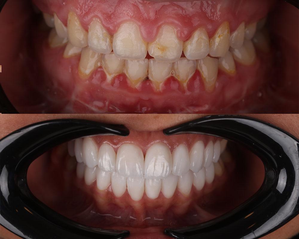 Dental veneers in Dubai