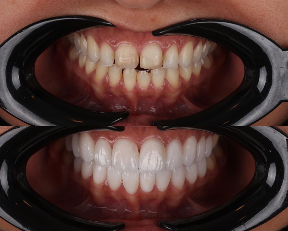 Dental veneers in Dubai