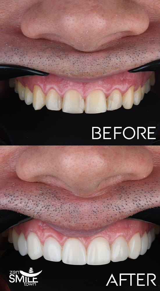 DENTAL TURKEY - COMPOSITE BONDING RESULTS2