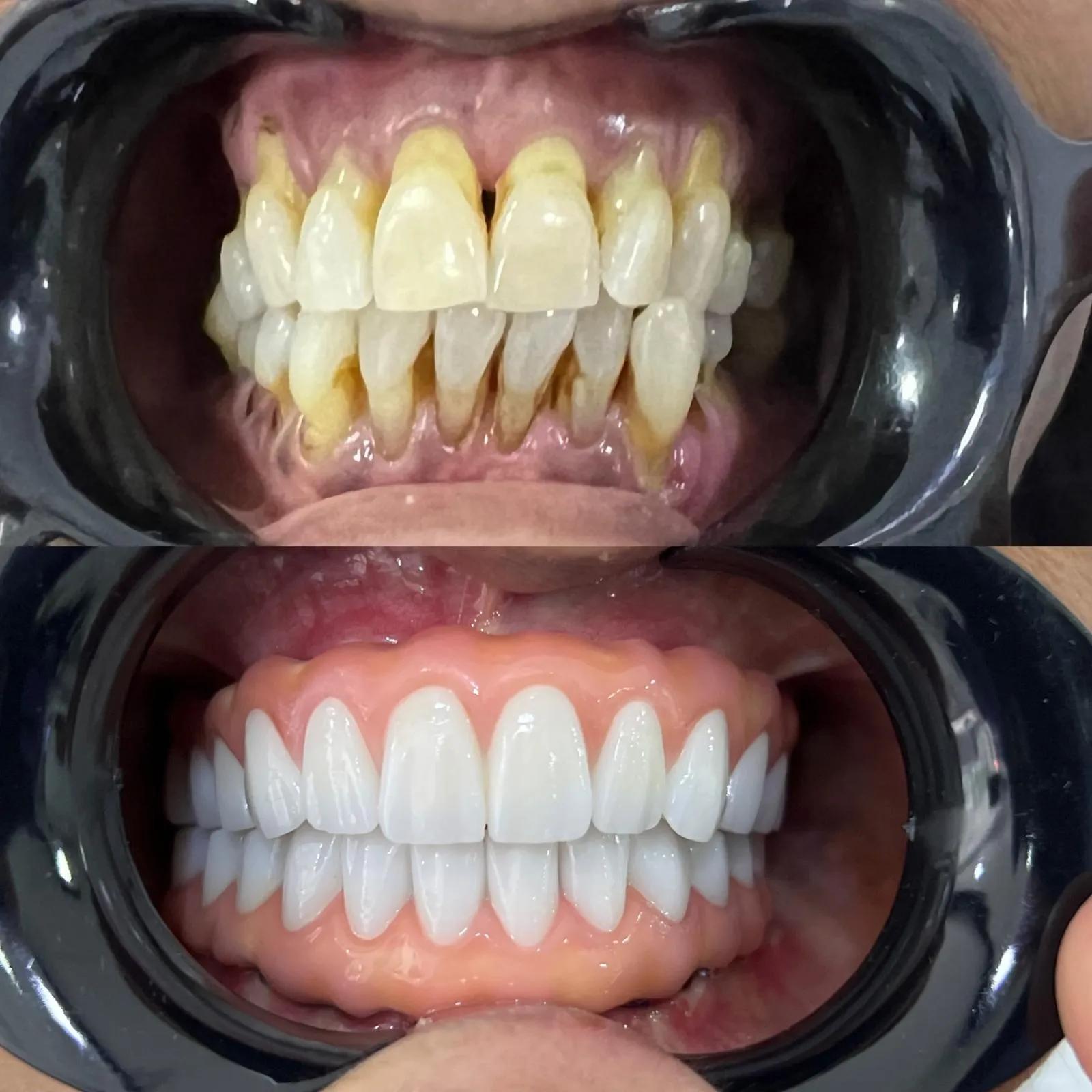 ALL ON 4 by Dentglow in Turkey 1