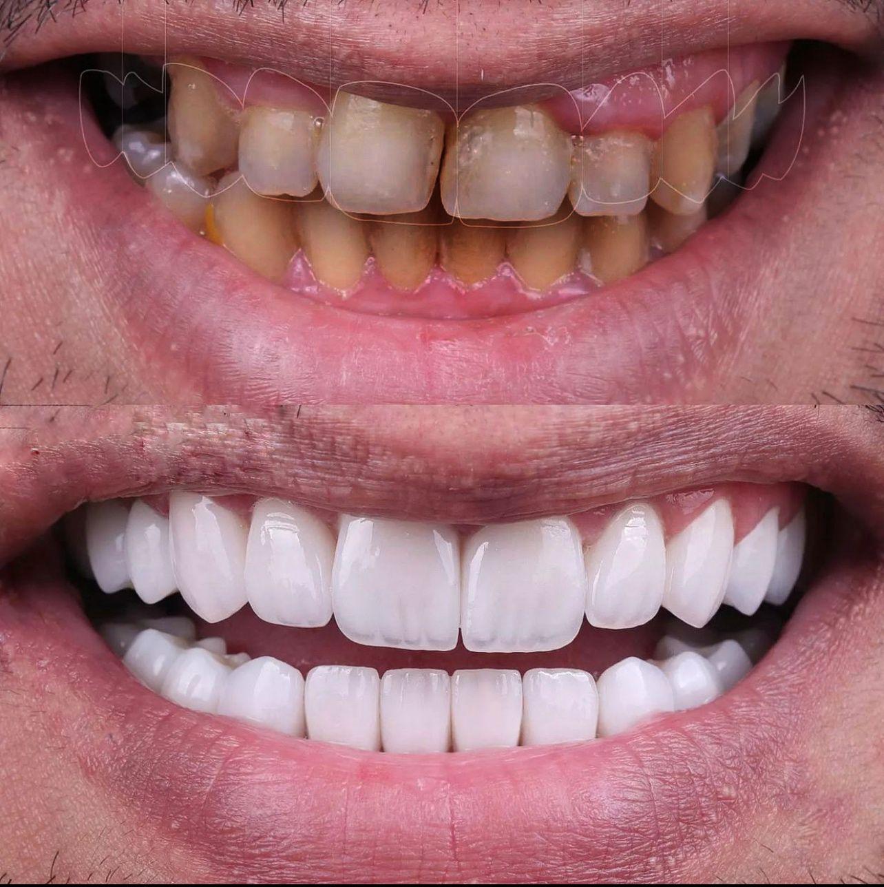 3- Before-after zirkon vaka