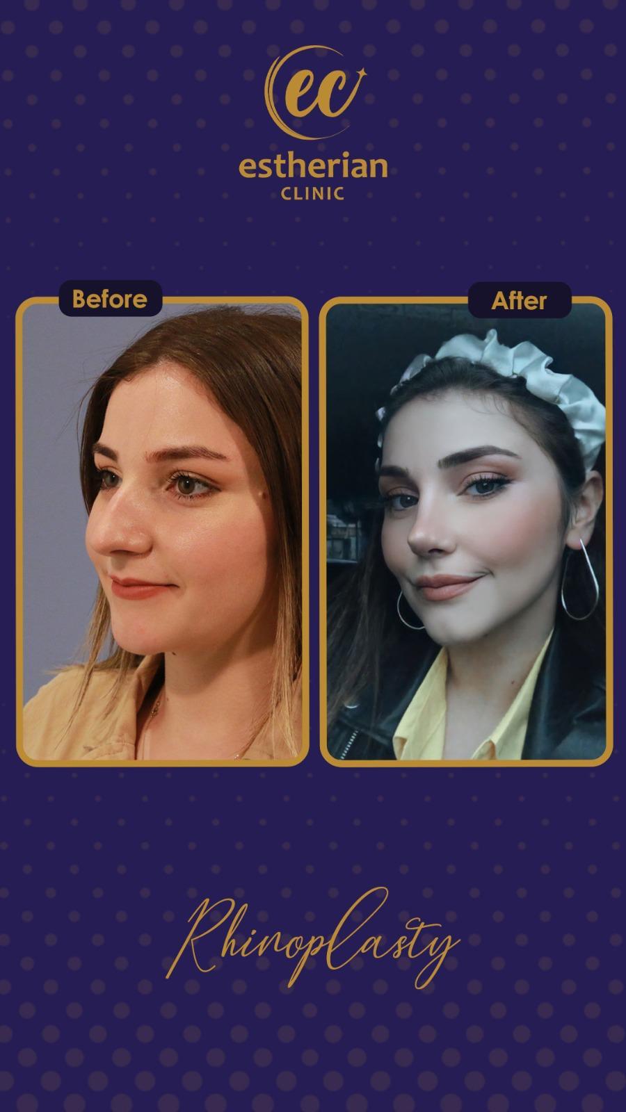 estherian Face Surgery 16-min