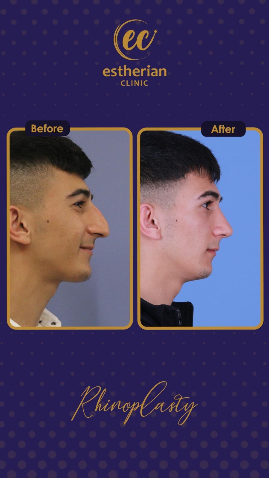 estherian Face Surgery 17-min