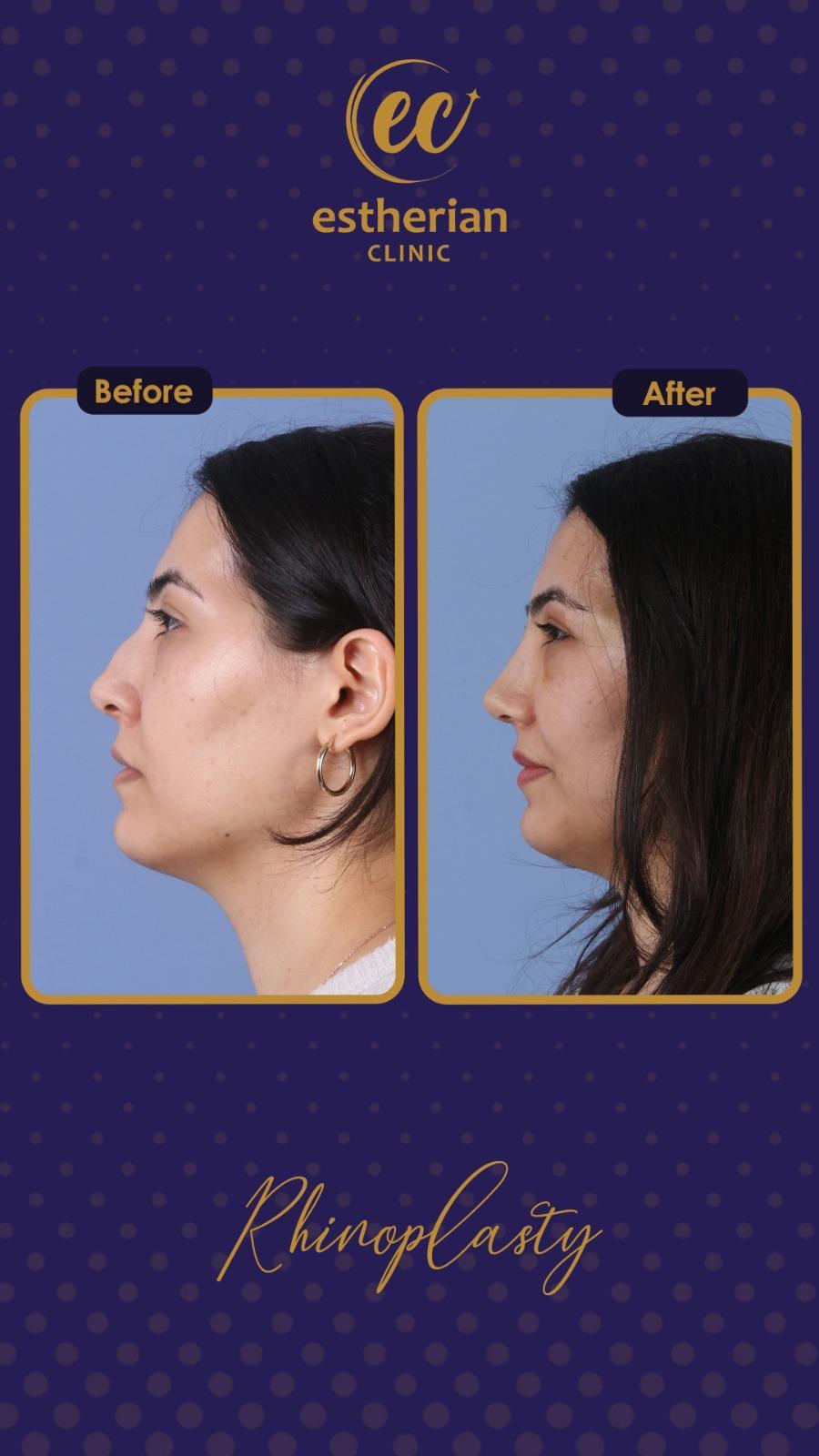 estherian Face Surgery 18-min