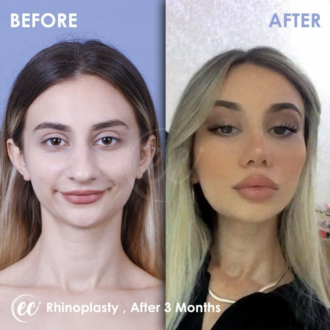 estherian Face Surgery 22-min