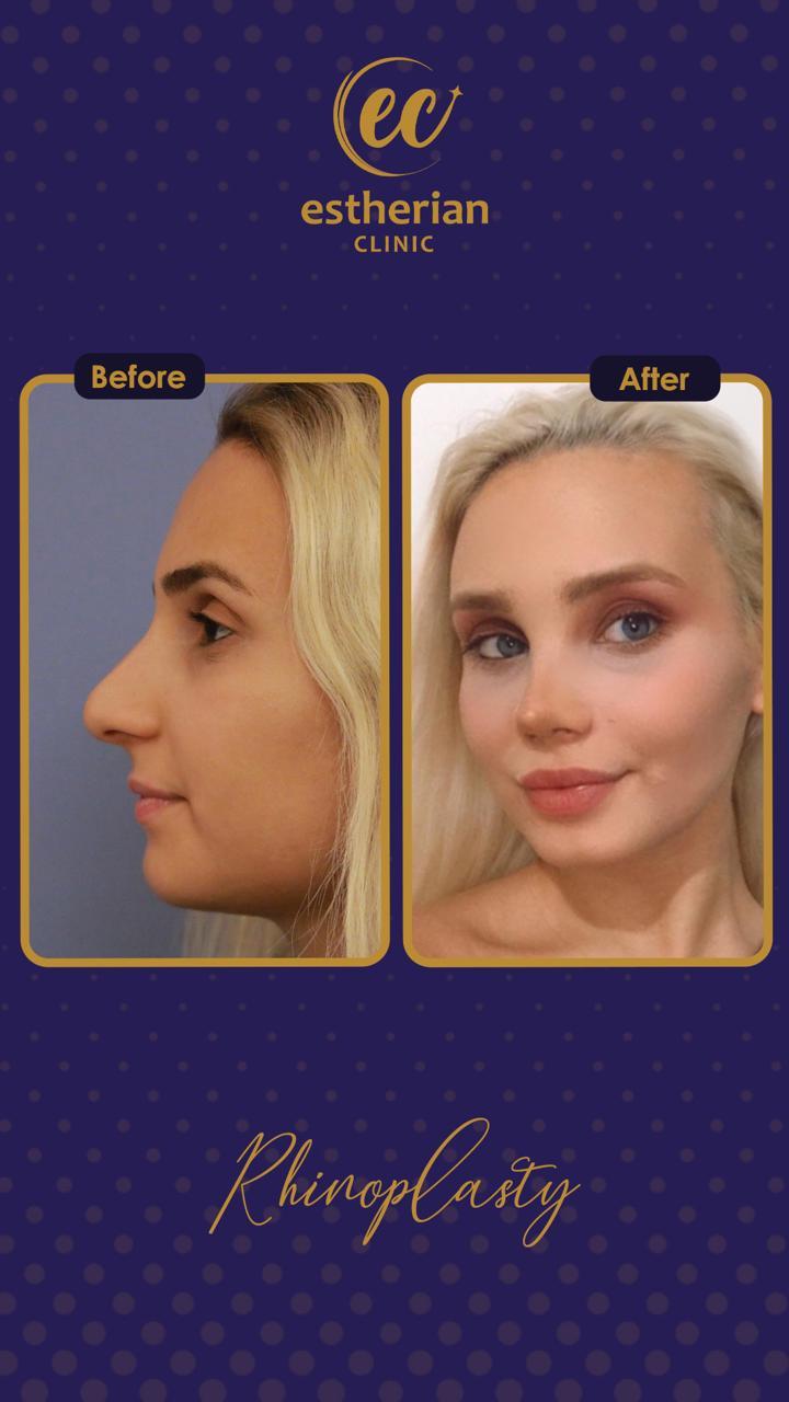 estherian Face Surgery 25-min