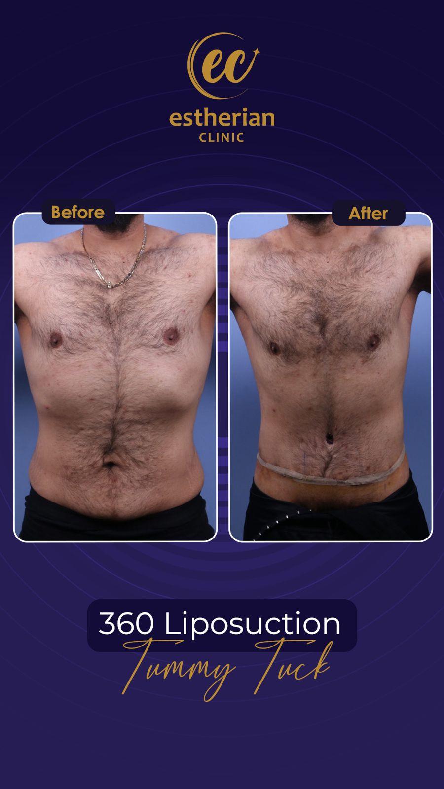 estherian BODY Surgery 17-min