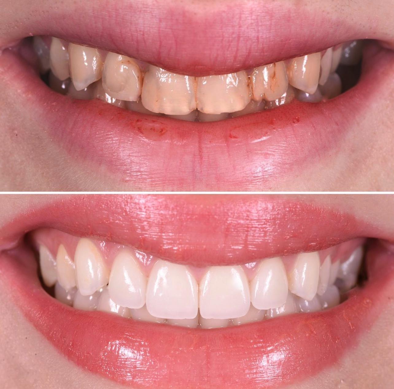 11- Before-after zirkon vaka